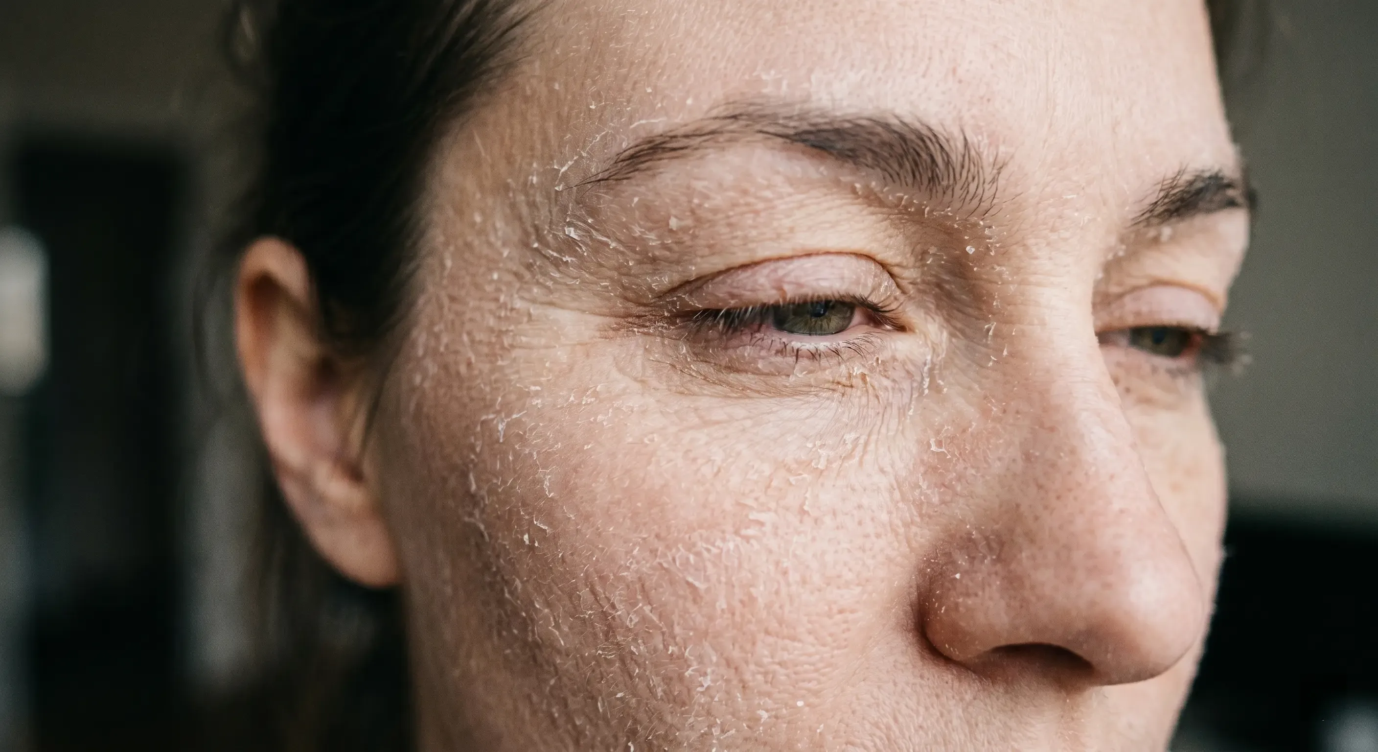 Skin Hydration and Luminosity