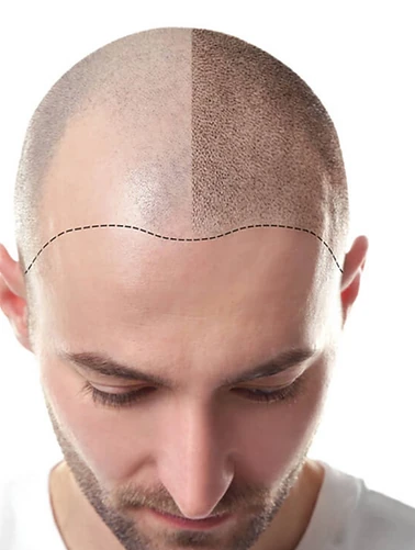 Scalp Micropigmentation?