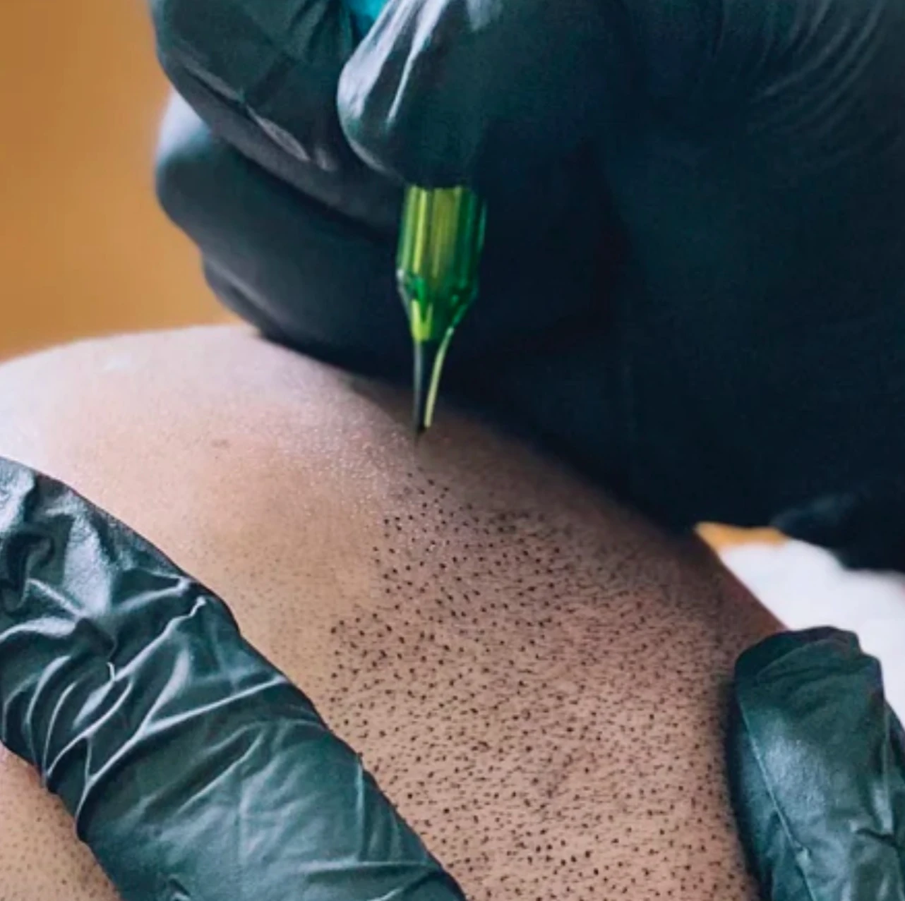 Scalp Micropigmentation